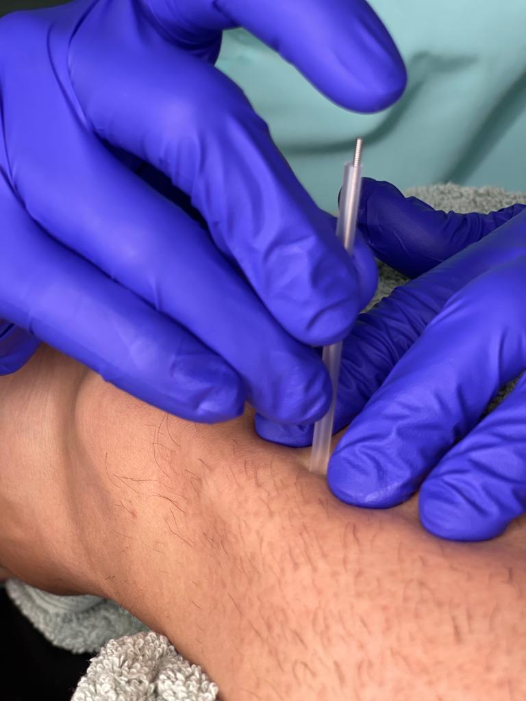 Fisioterapia en San Pedro de Alcantara y Marbella